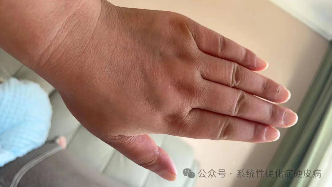 硬皮病最新藥物治療進展與新藥研究概述